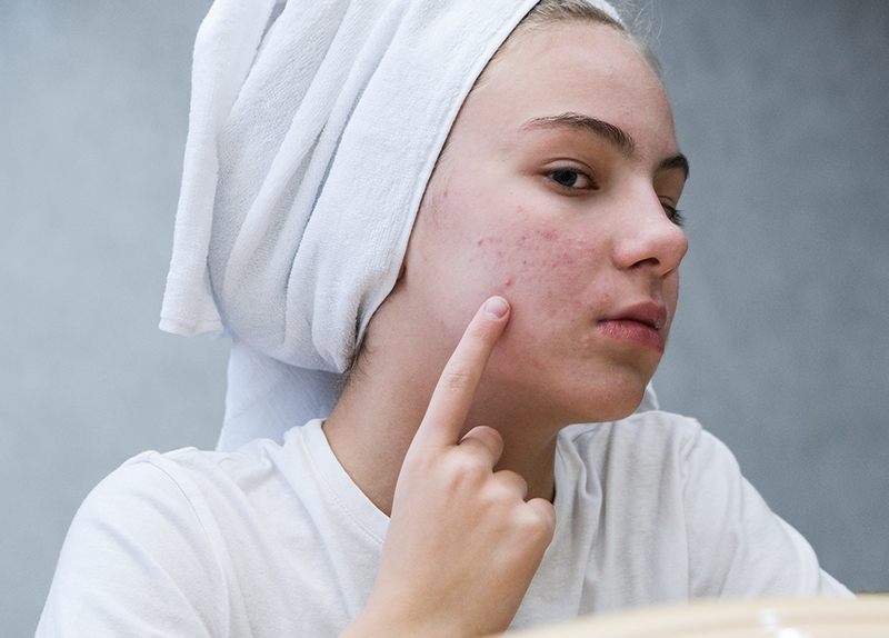Understanding Acne: Causes and Fixes0
