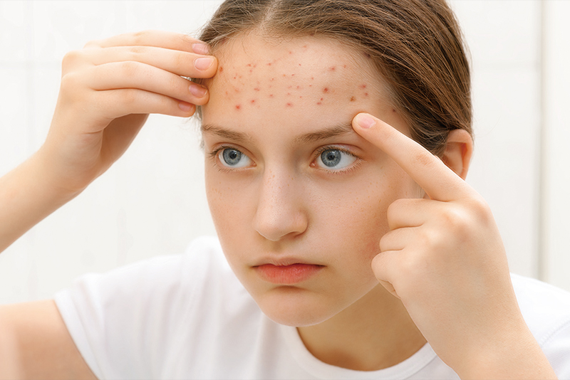 Practical Pimple Care Tips0