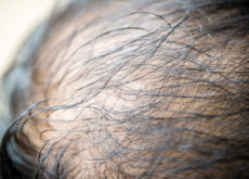 How to Prevent Hair Loss - Science