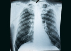 Mycoplasma Pneumonia - Focus